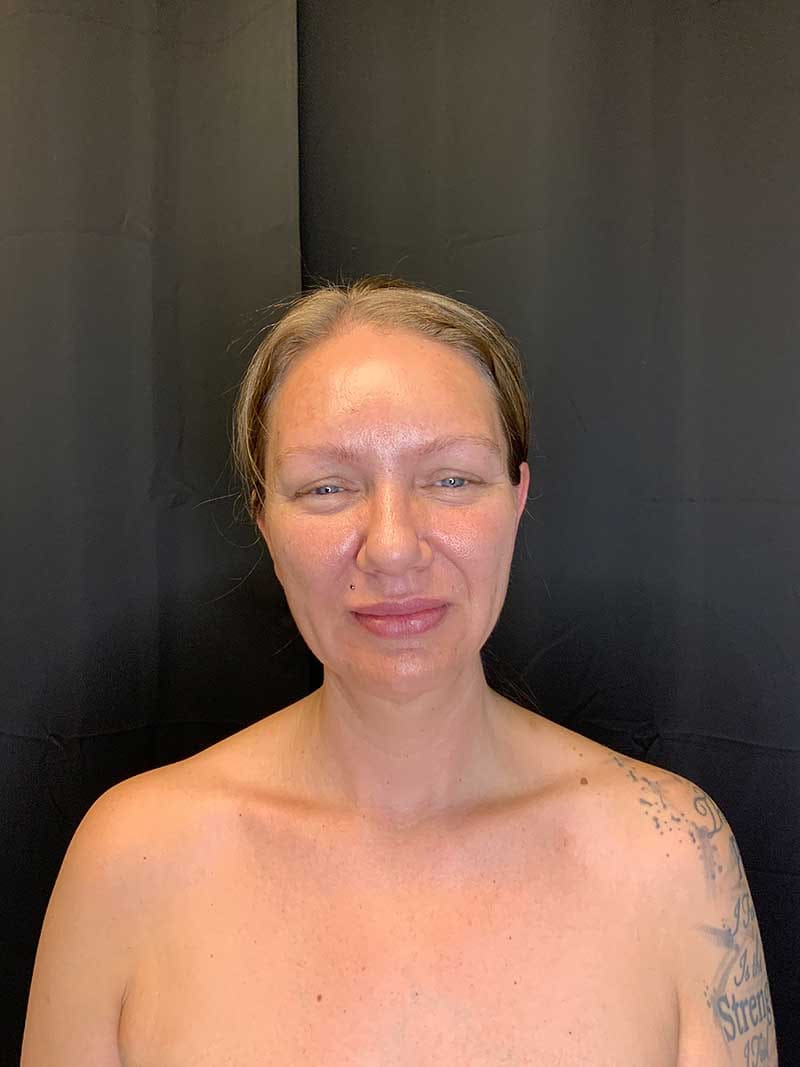Facial Fat Transfer Before & After Image