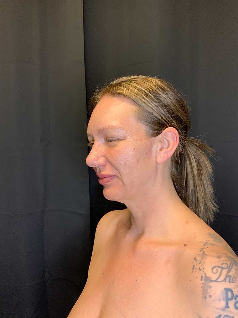 Facial Fat Transfer Before & After Image