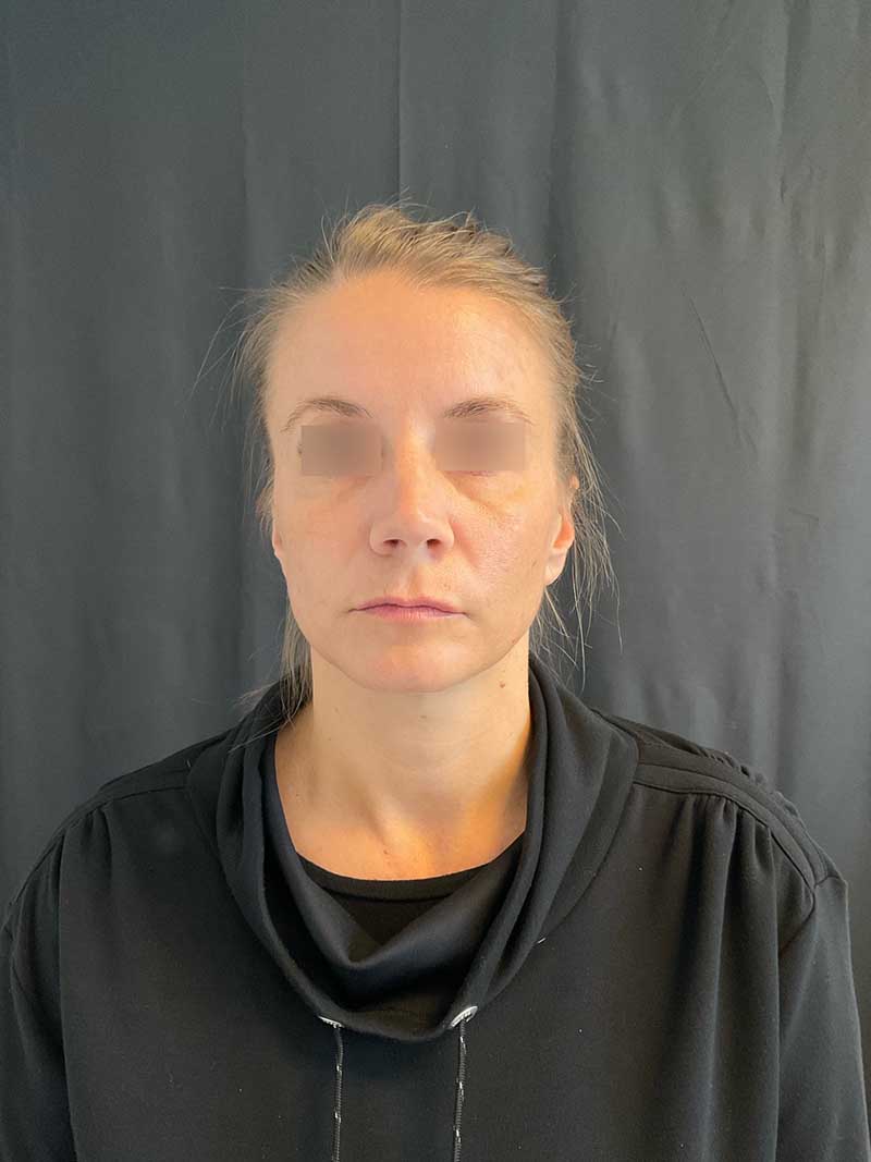 Facial Fat Transfer Before & After Image