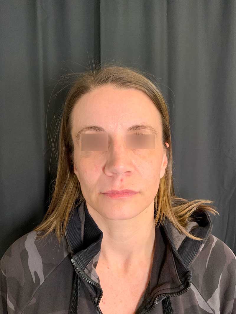 Facial Fat Transfer Before & After Image