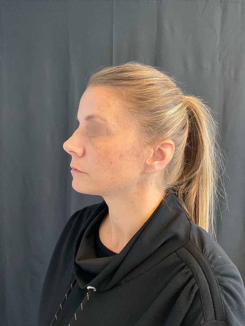 Facial Fat Transfer Before & After Image