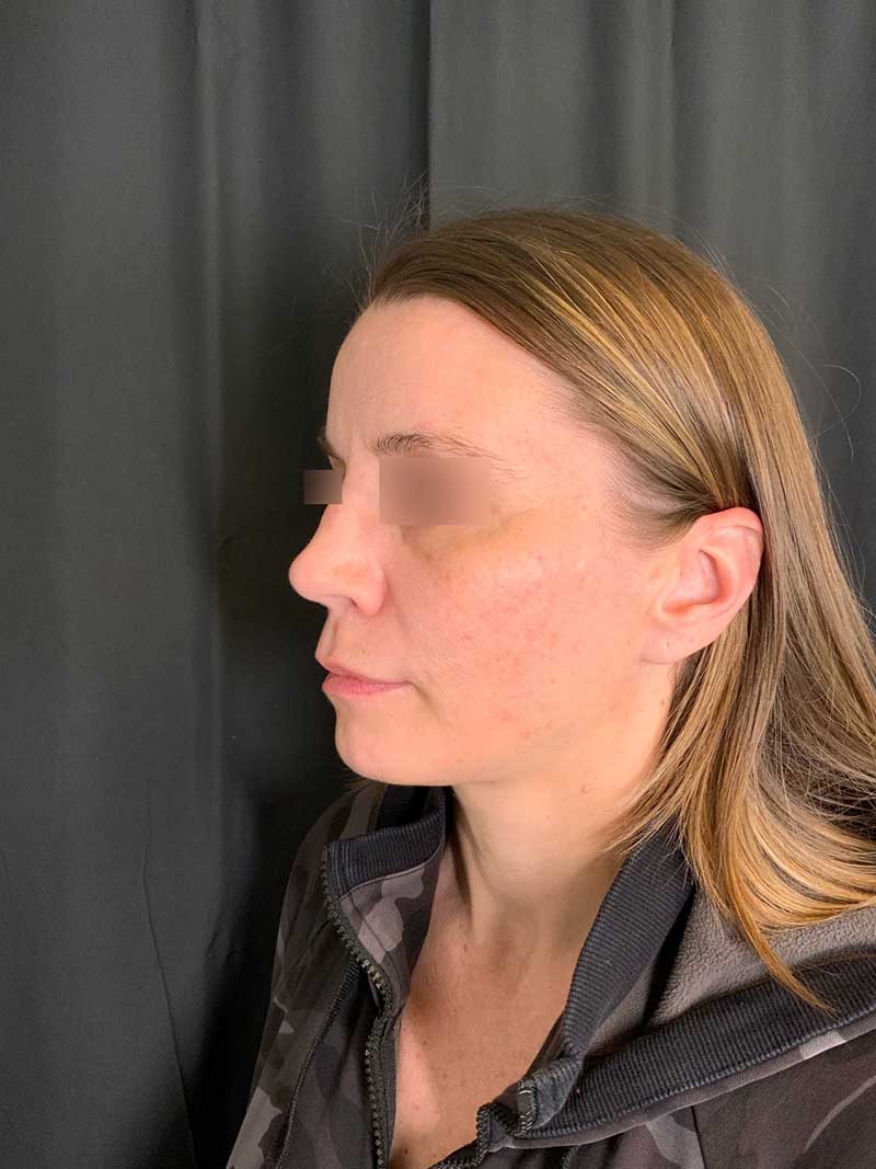 Facial Fat Transfer Before & After Image