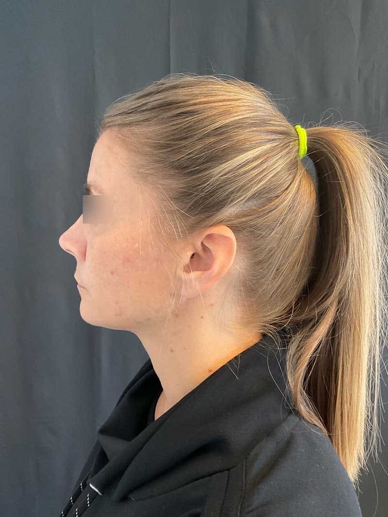 Facial Fat Transfer Before & After Image