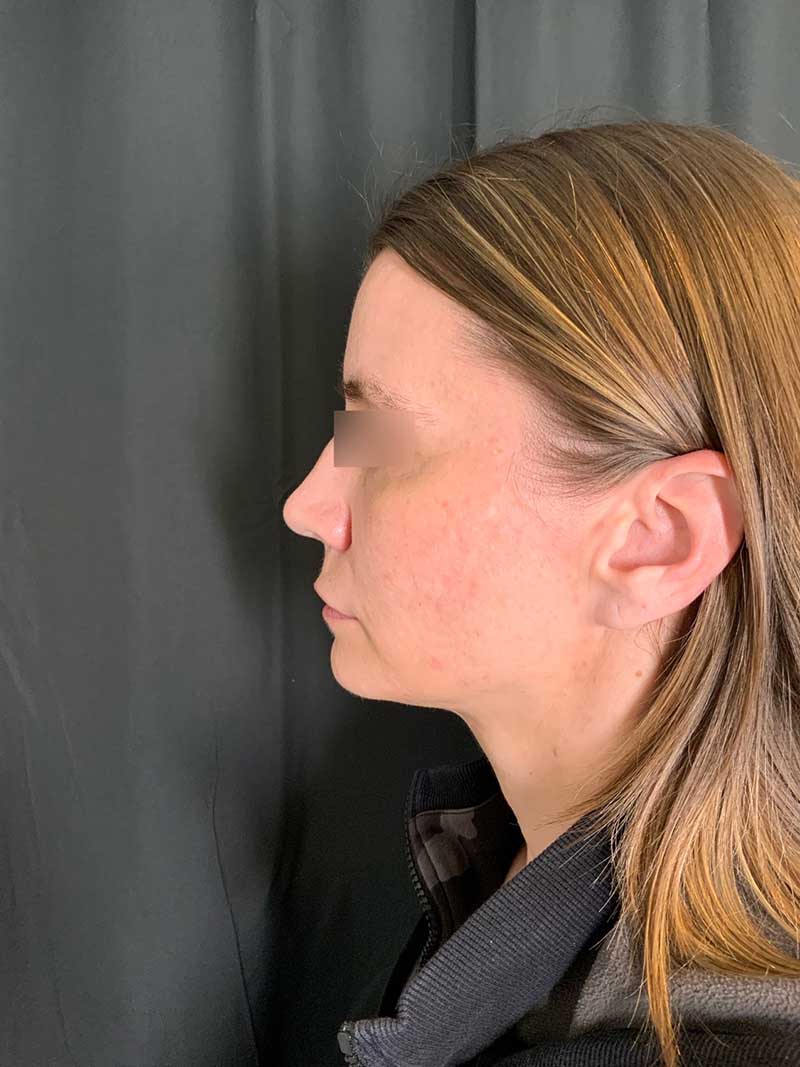 Facial Fat Transfer Before & After Image