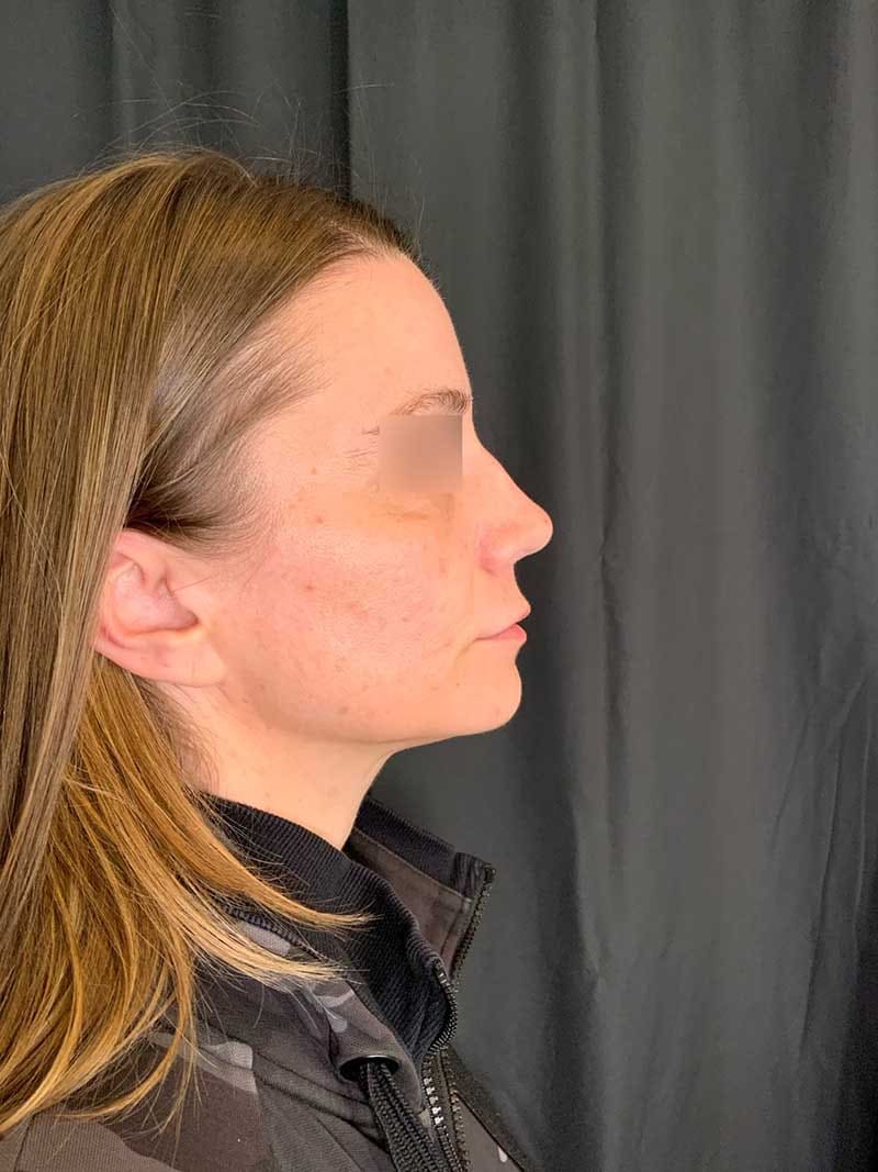 Facial Fat Transfer Before & After Image