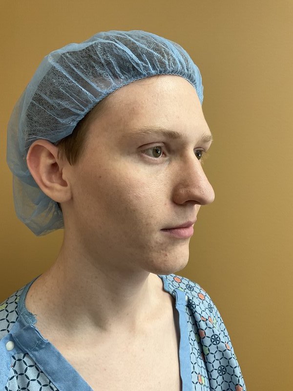 Facial Fat Transfer Before & After Image