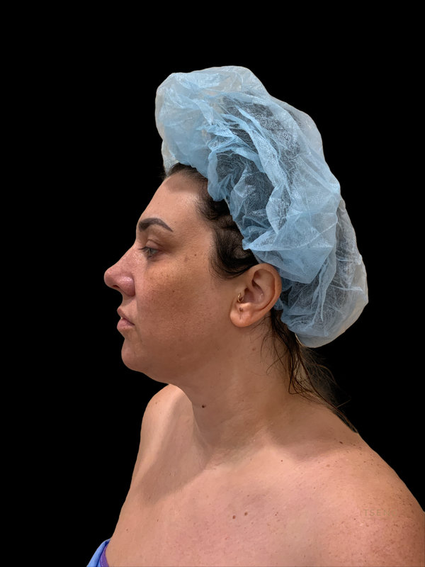 Facial Fat Transfer Before & After Image