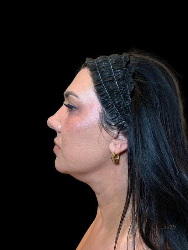 Facial Fat Transfer Before & After Image