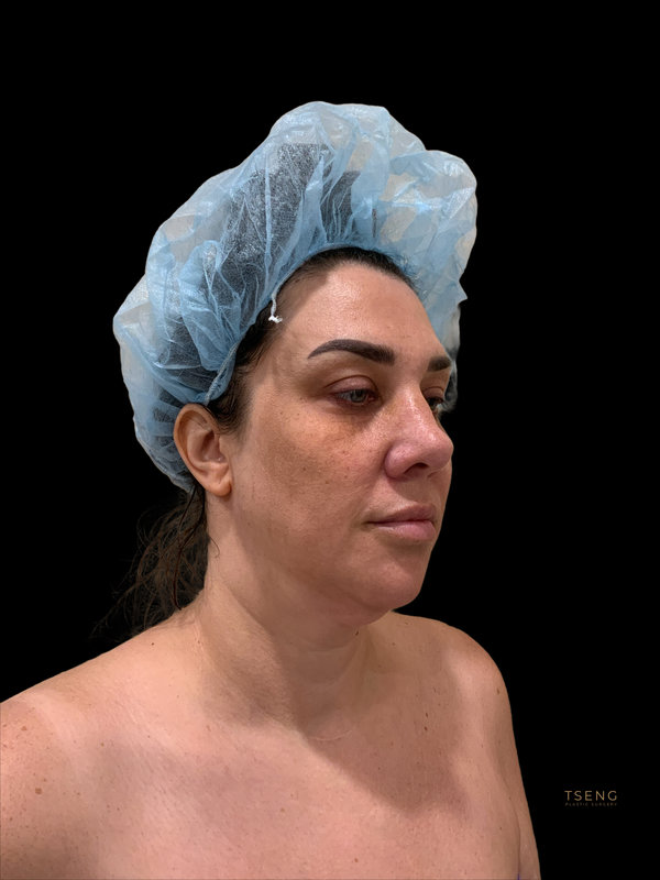 Facial Fat Transfer Before & After Image