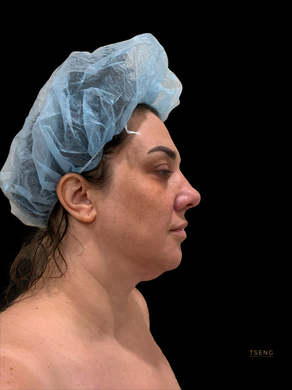 Facial Fat Transfer Before & After Image