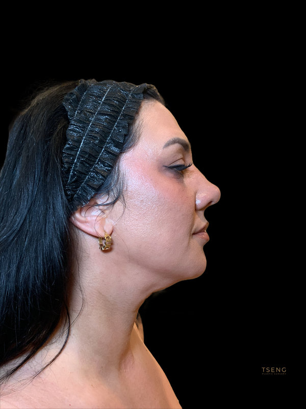 Facial Fat Transfer Before & After Image