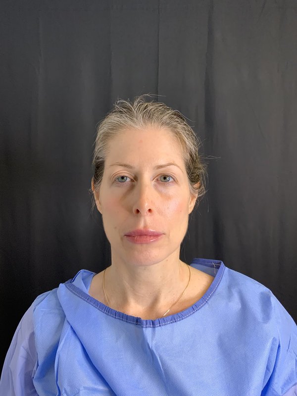 Facial Fat Transfer Before & After Image