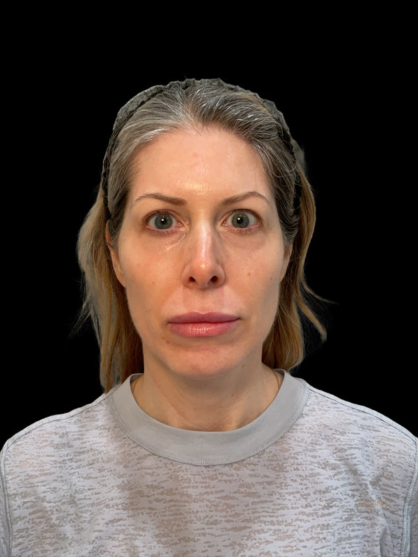 Facial Fat Transfer Before & After Image