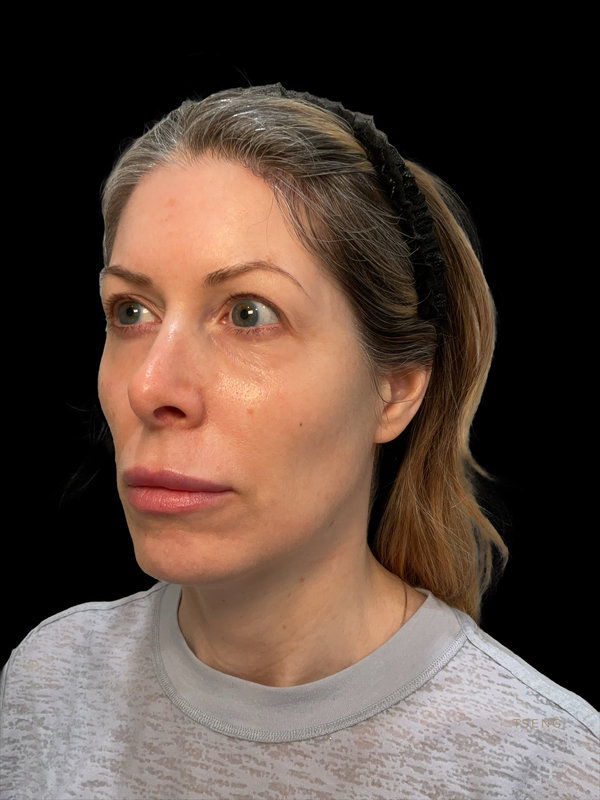Facial Fat Transfer Before & After Image