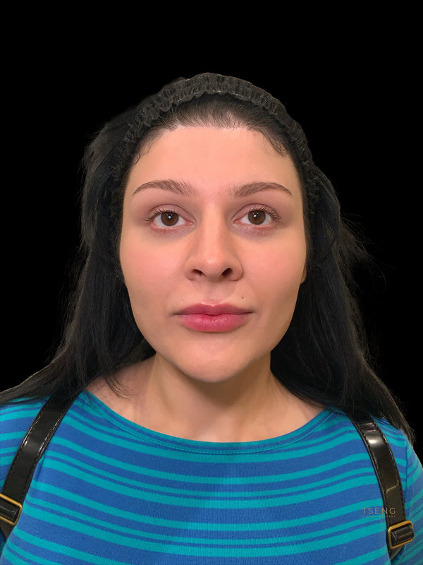 Facial Fat Transfer Before & After Image