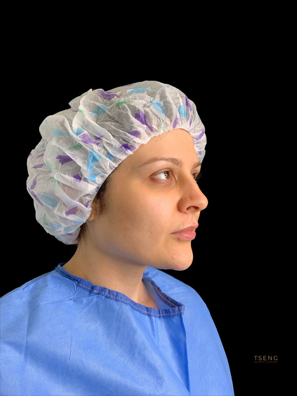 Facial Fat Transfer Before & After Image
