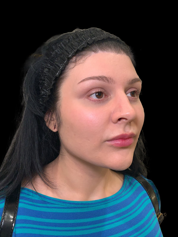 Facial Fat Transfer Before & After Image