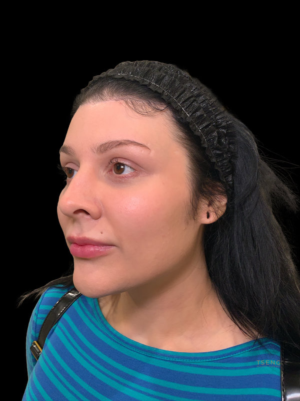 Facial Fat Transfer Before & After Image