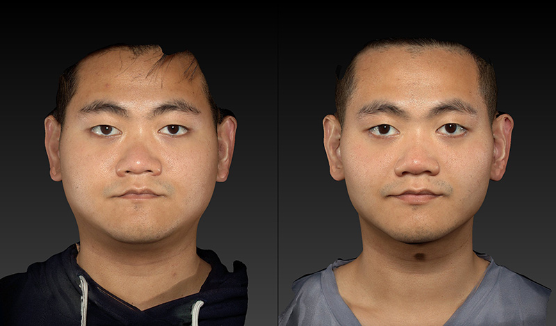 Liposculpting Before & After Image