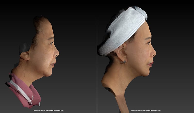 Neck Lift Before & After Image