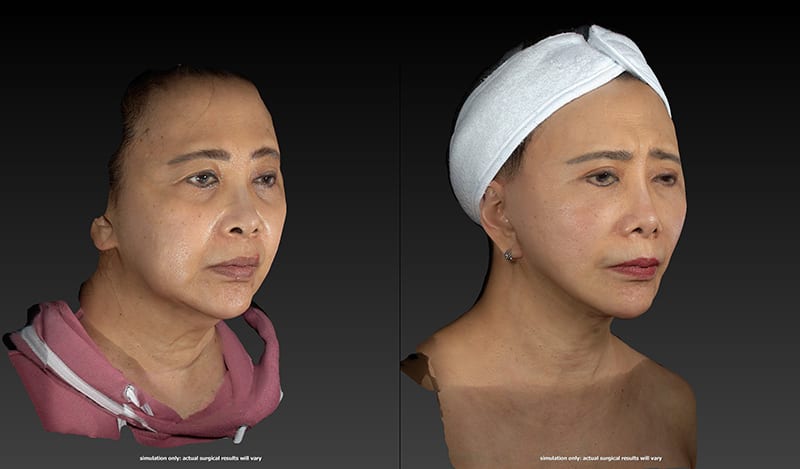 Neck Lift Before & After Image