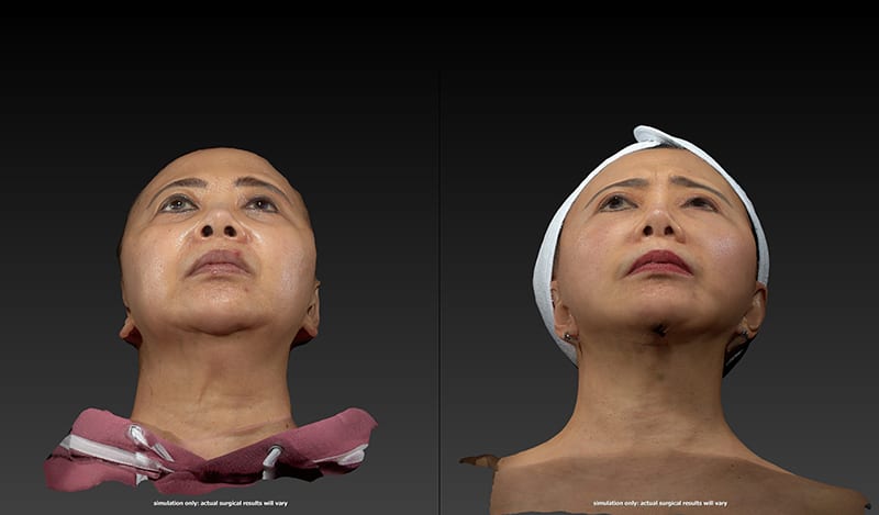 Neck Lift Before & After Image