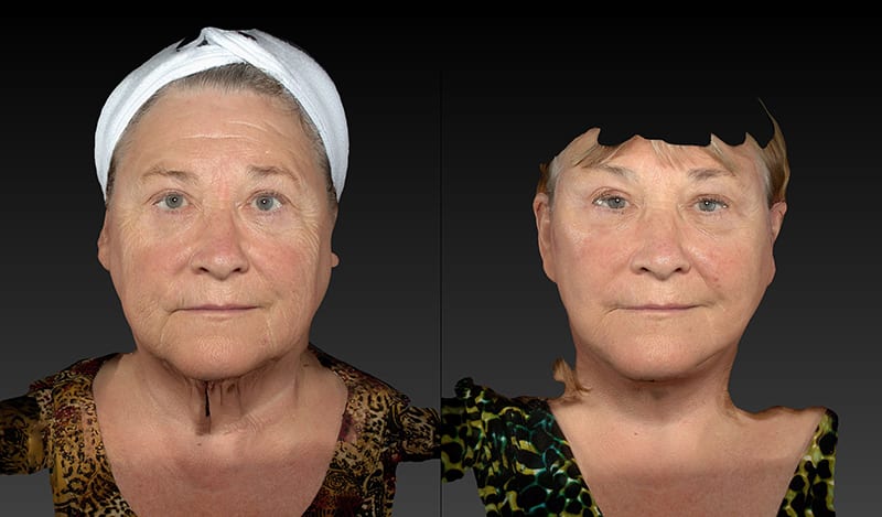 Neck Lift Before & After Image