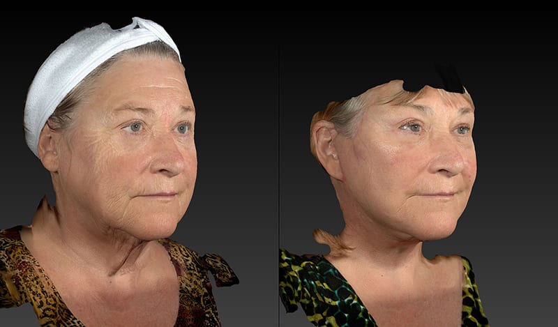 Neck Lift Before & After Image