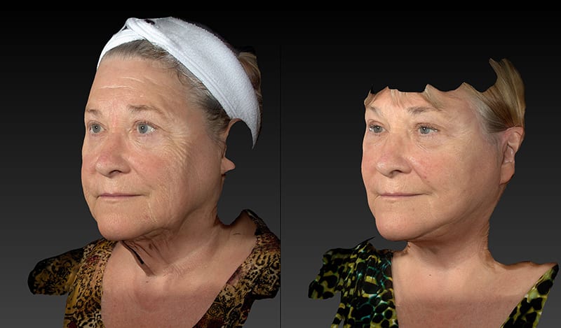 Neck Lift Before & After Image