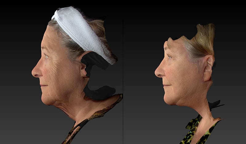 Neck Lift Before & After Image