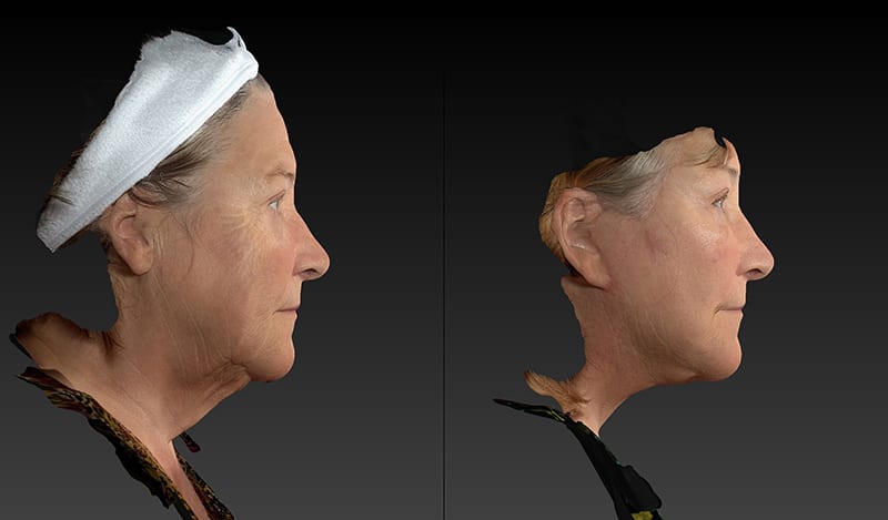 Neck Lift Before & After Image