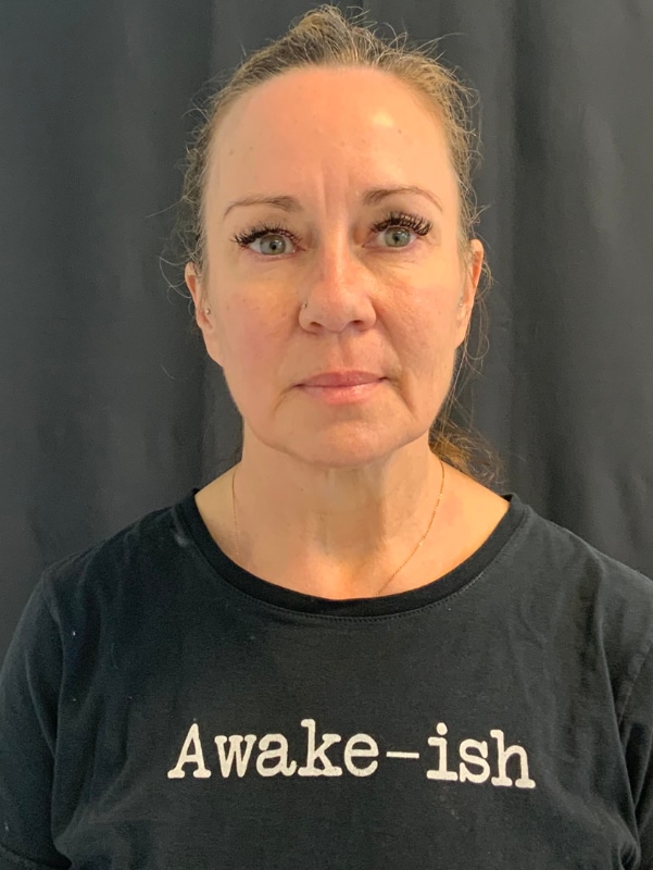 Neck Lift Before & After Image