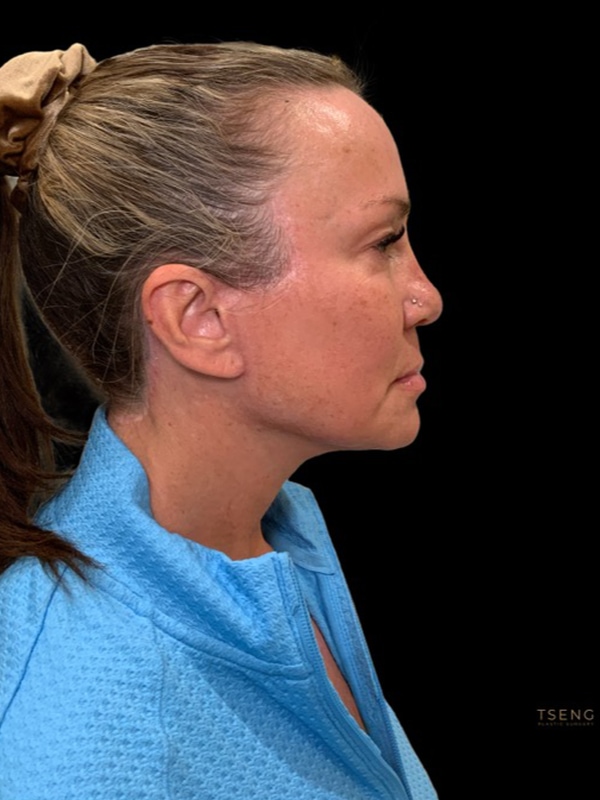 Neck Lift Before & After Image