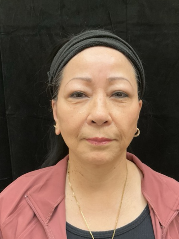 Neck Lift Before & After Image