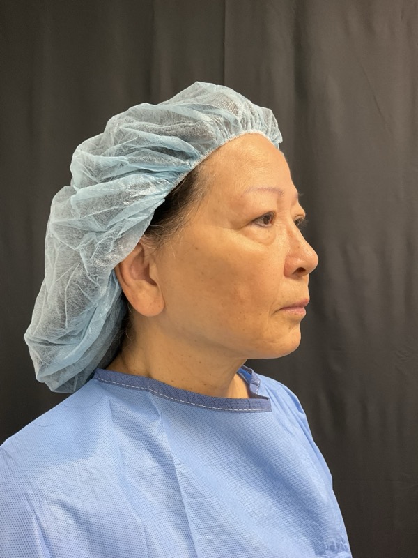 Neck Lift Before & After Image