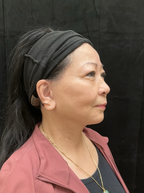 Neck Lift Before & After Image