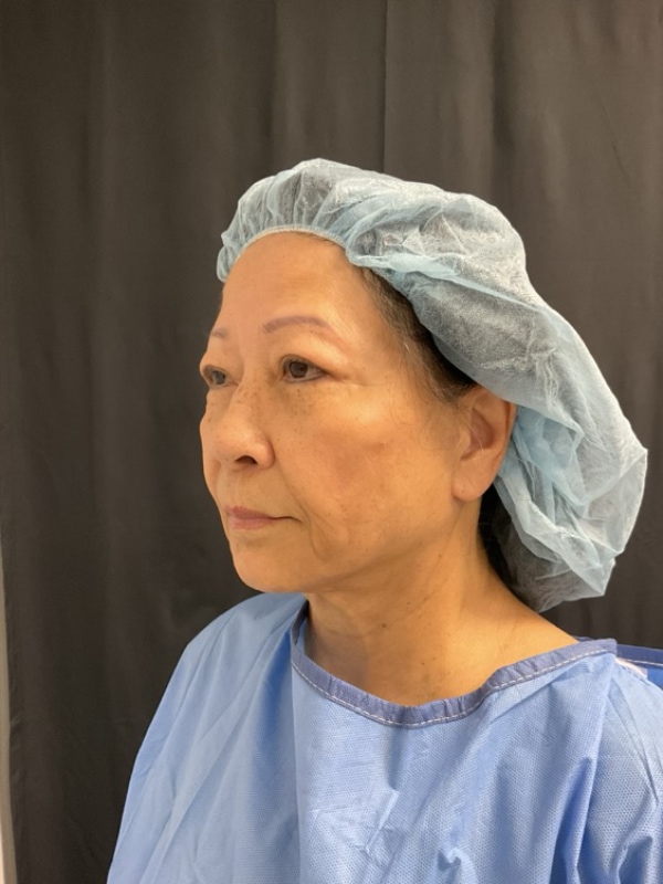 Neck Lift Before & After Image
