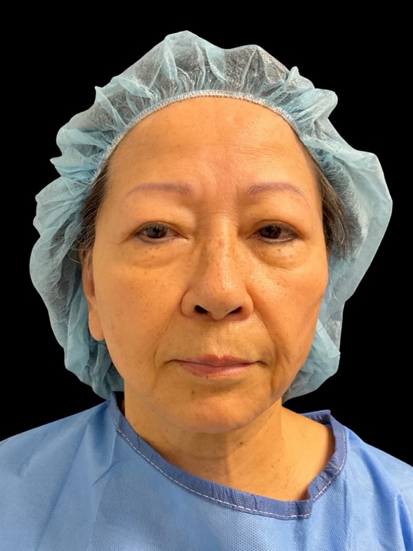 Preservation Facelift Before & After Image