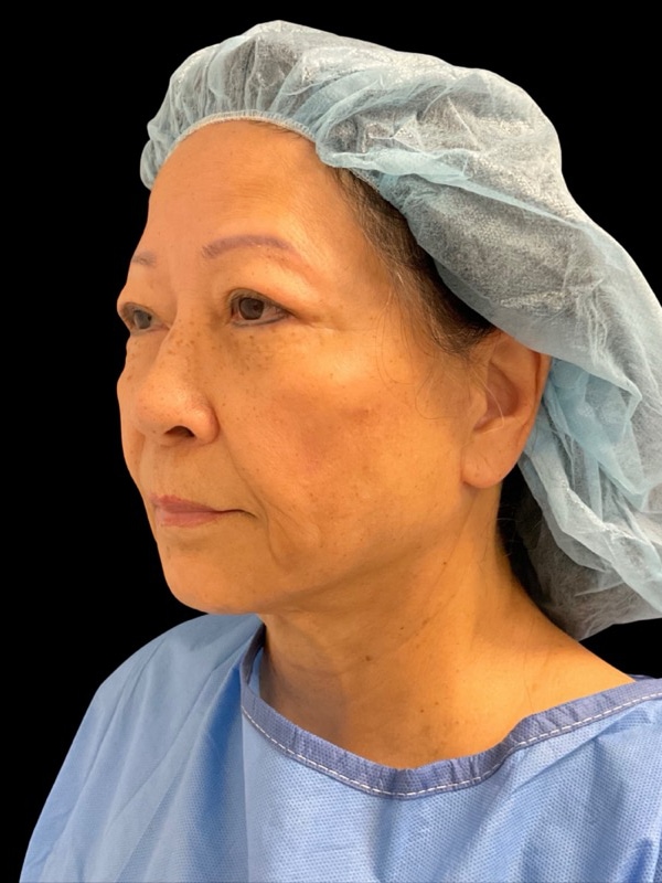 Preservation Facelift Before & After Image