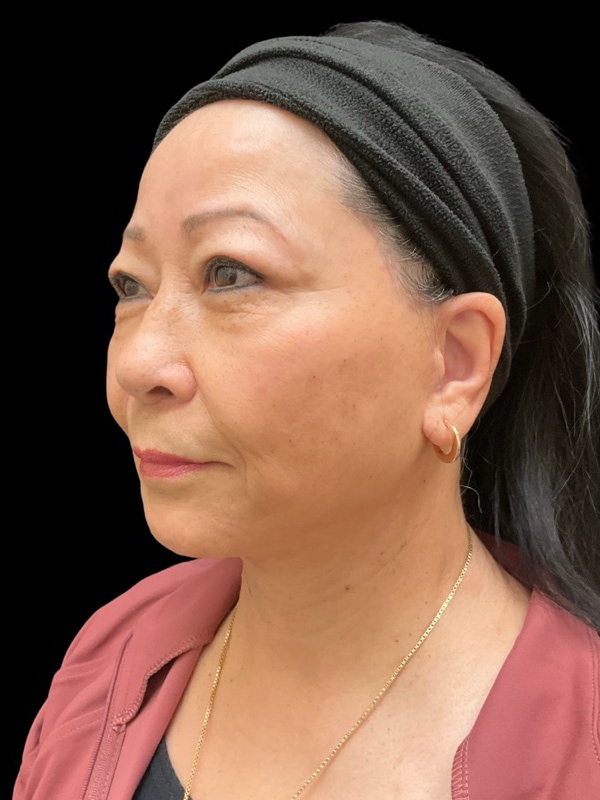 Preservation Facelift Before & After Image
