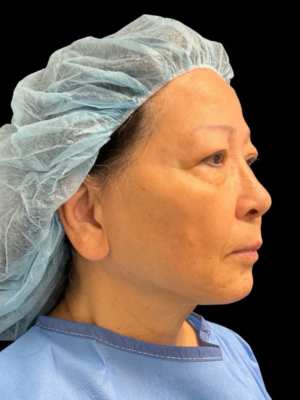 Preservation Facelift Before & After Image