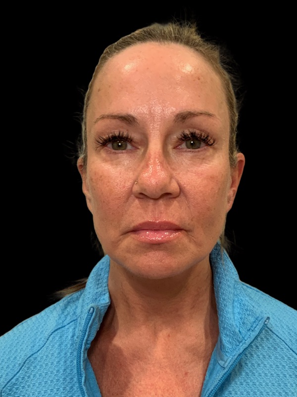 Preservation Facelift Before & After Image