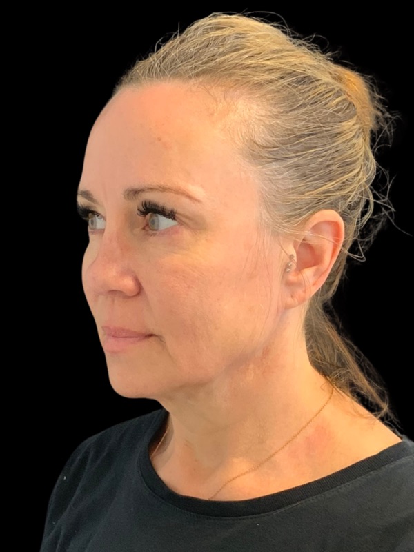 Preservation Facelift Before & After Image