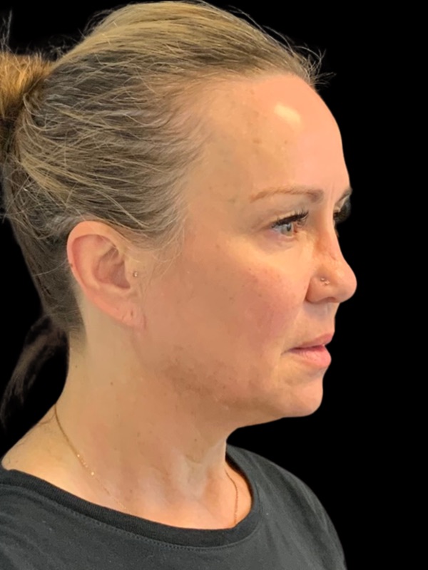 Preservation Facelift Before & After Image