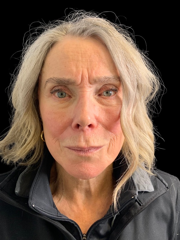 Preservation Facelift Before & After Image