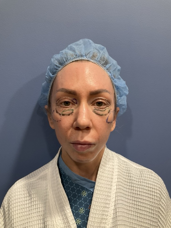 Preservation Facelift Before & After Image