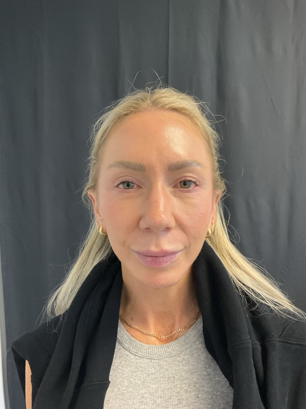 Preservation Facelift Before & After Image