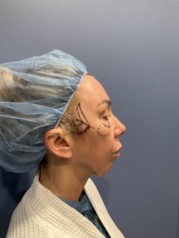 Preservation Facelift Before & After Image