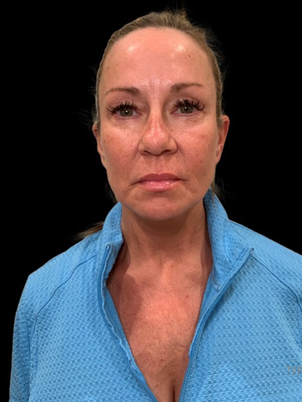 Preservation Facelift Before & After Image
