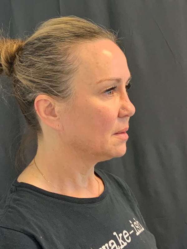 Preservation Facelift Before & After Image